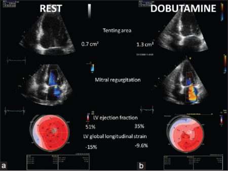 Dobutamine Stress Echo